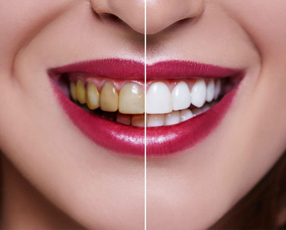 Wisdom Tooth Treatment