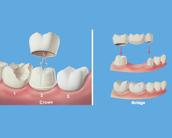 Wisdom Tooth Treatment