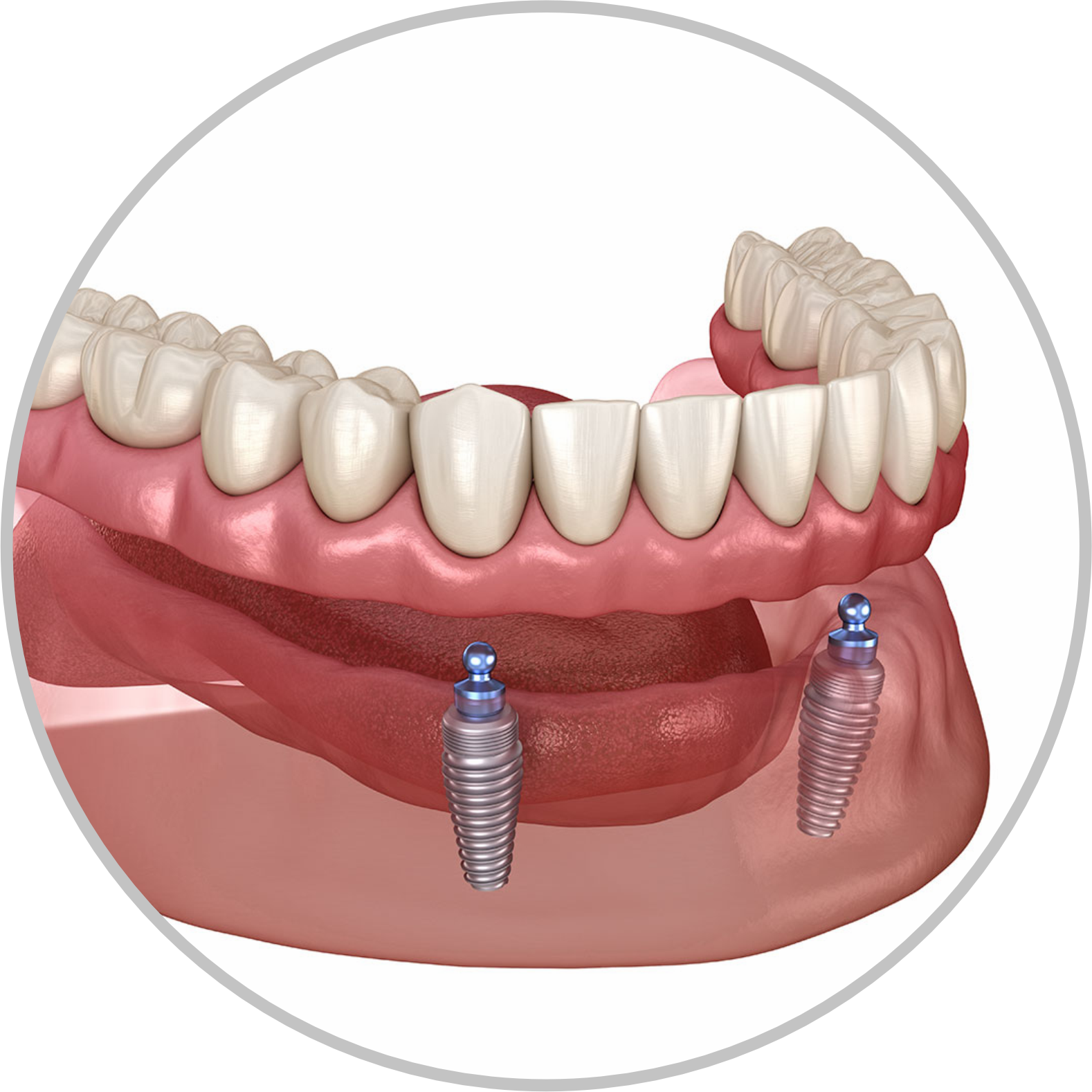 Implant Based Denture